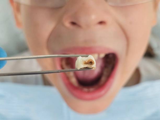 Best Emergency Tooth Extraction in Poteau, OK